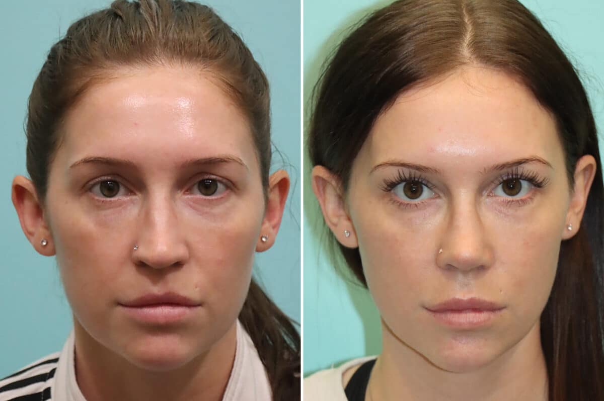 Before and after Rhinoplasty by Dr. Shervin Naderi, Patient 25244