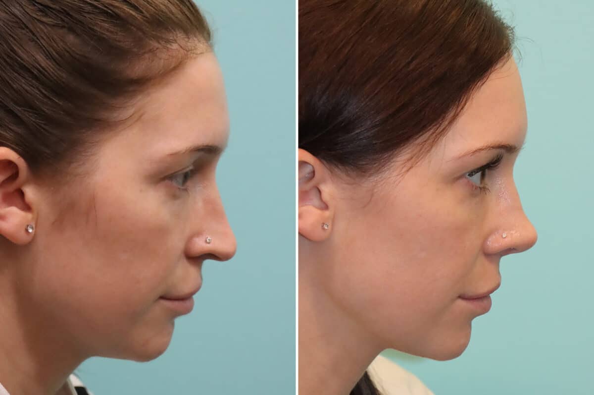 Before and after Rhinoplasty by Dr. Shervin Naderi, Patient 25244