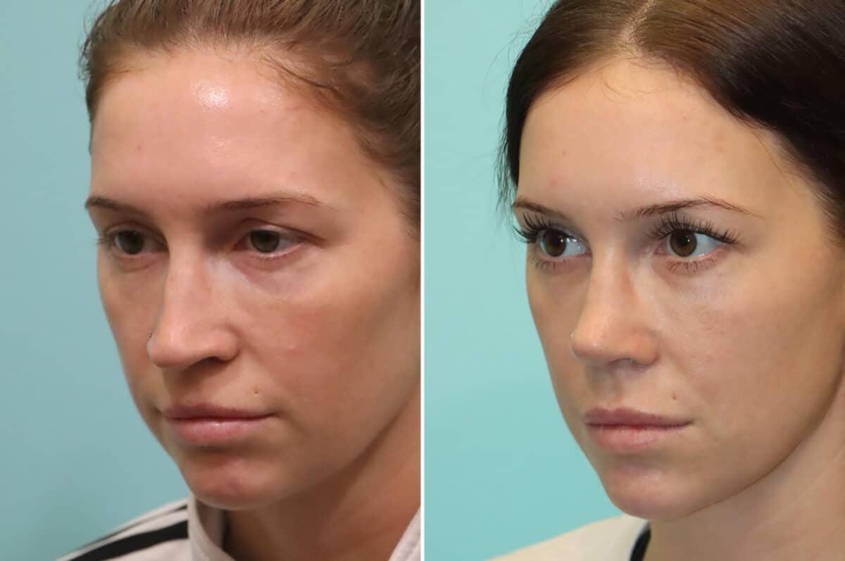 Before and after Rhinoplasty by Dr. Shervin Naderi, Patient 25244