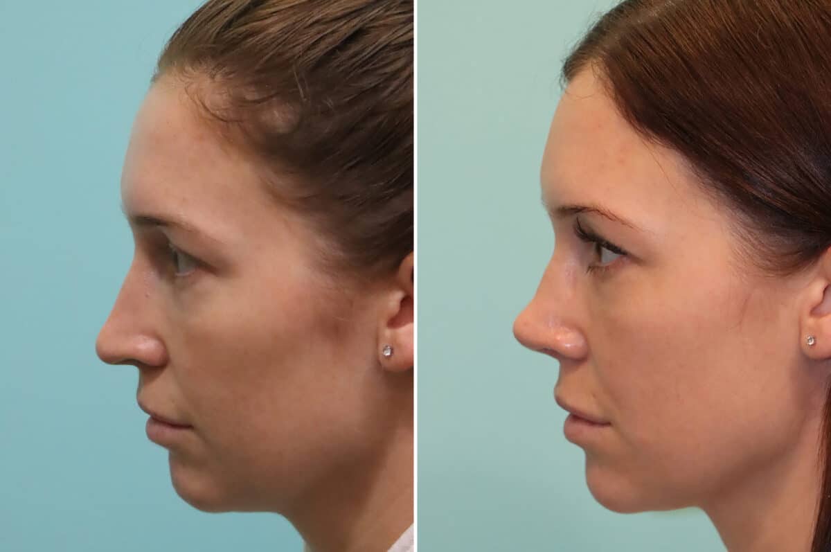 Before and after Rhinoplasty by Dr. Shervin Naderi, Patient 25244