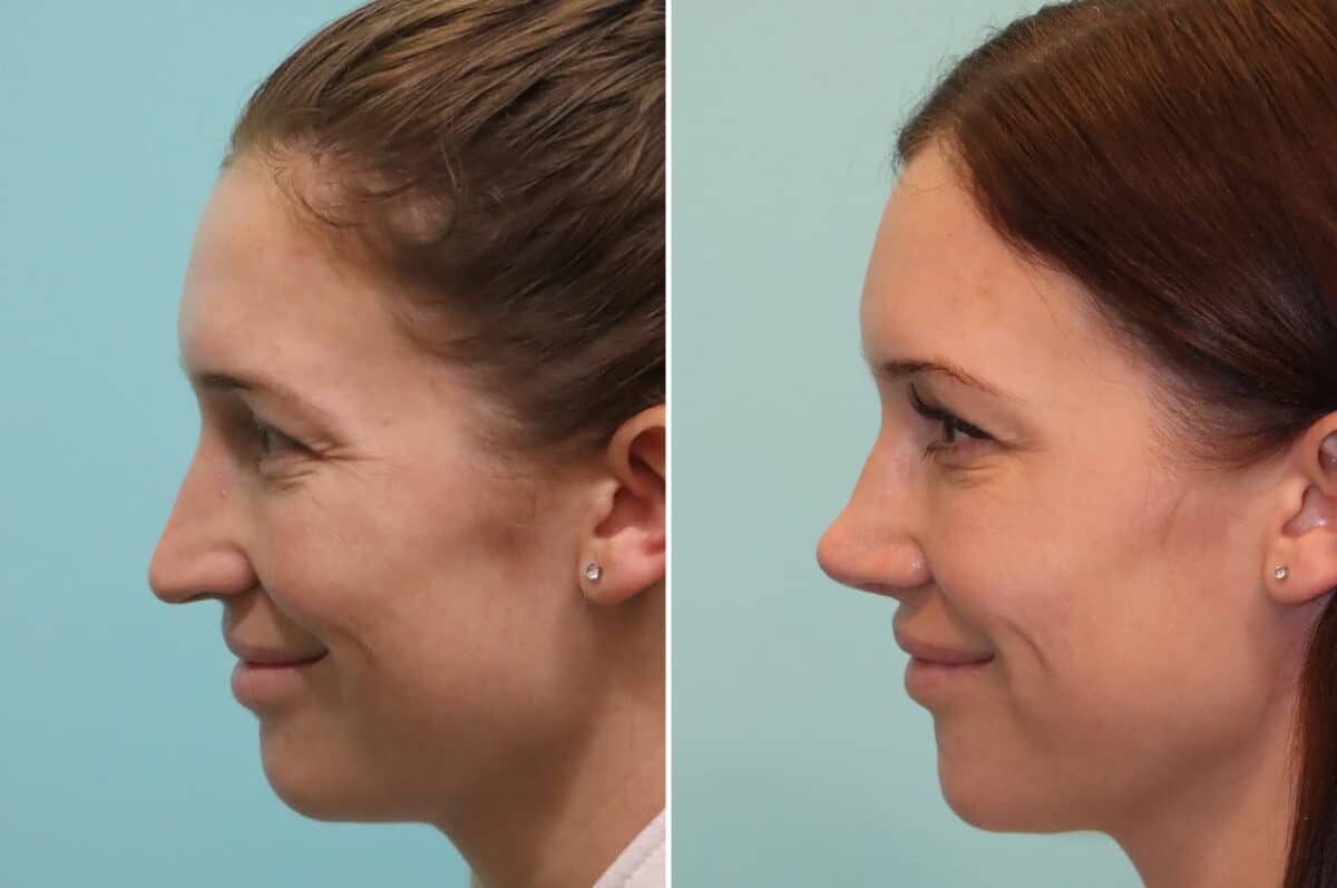 Before and after Rhinoplasty by Dr. Shervin Naderi, Patient 25244