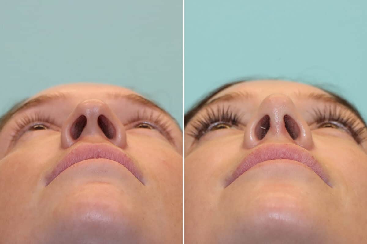 Before and after Rhinoplasty by Dr. Shervin Naderi, Patient 25244