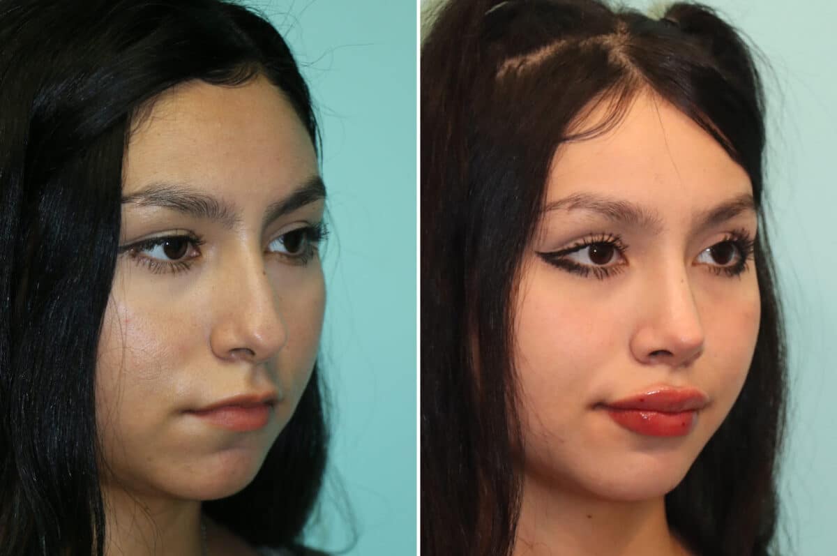 Before and after Rhinoplasty by Dr. Shervin Naderi, Patient 25270