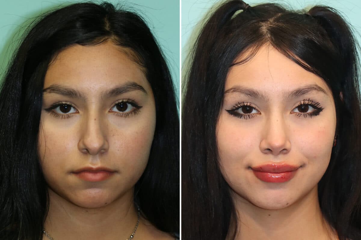 Before and after Rhinoplasty by Dr. Shervin Naderi, Patient 25270