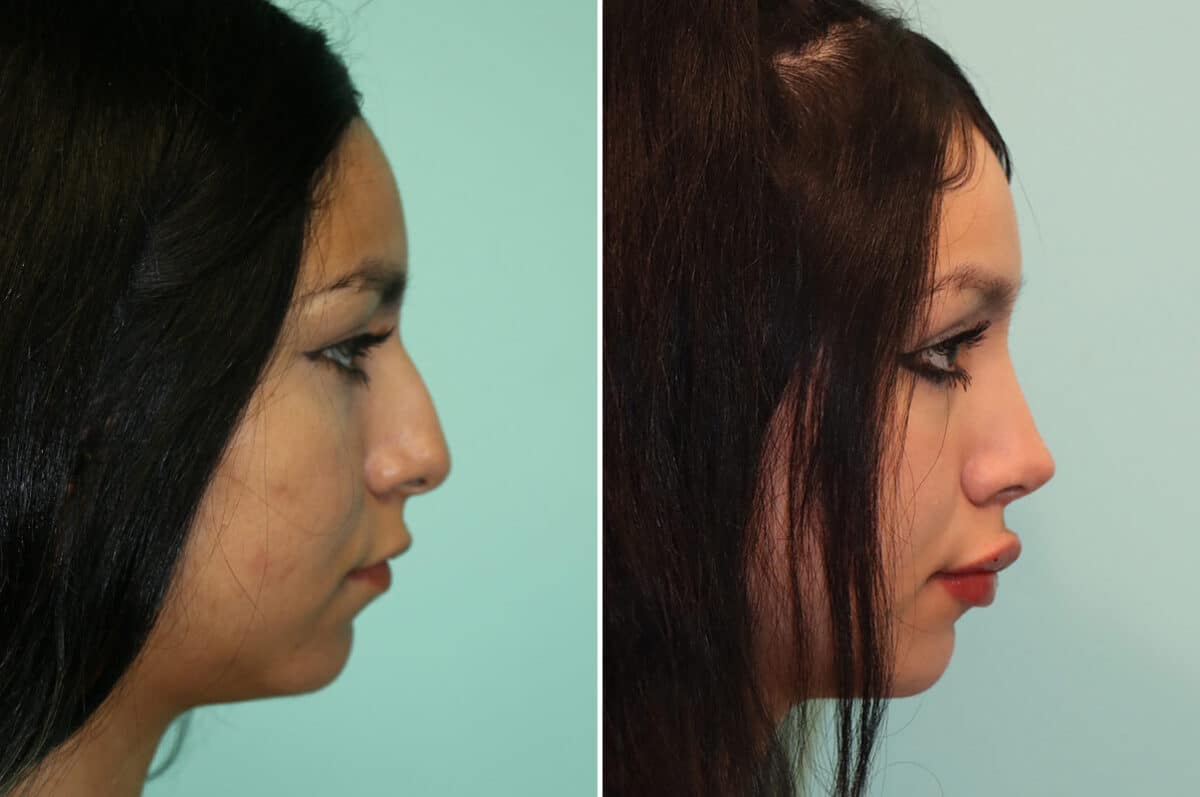 Before and after Rhinoplasty by Dr. Shervin Naderi, Patient 25270