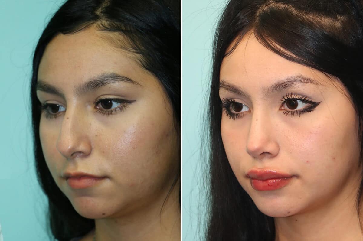 Before and after Rhinoplasty by Dr. Shervin Naderi, Patient 25270