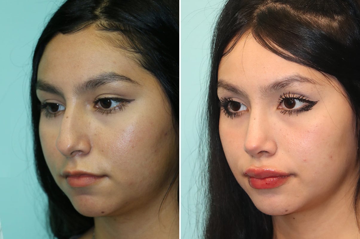 patient-25270-rhinoplasty-before-after