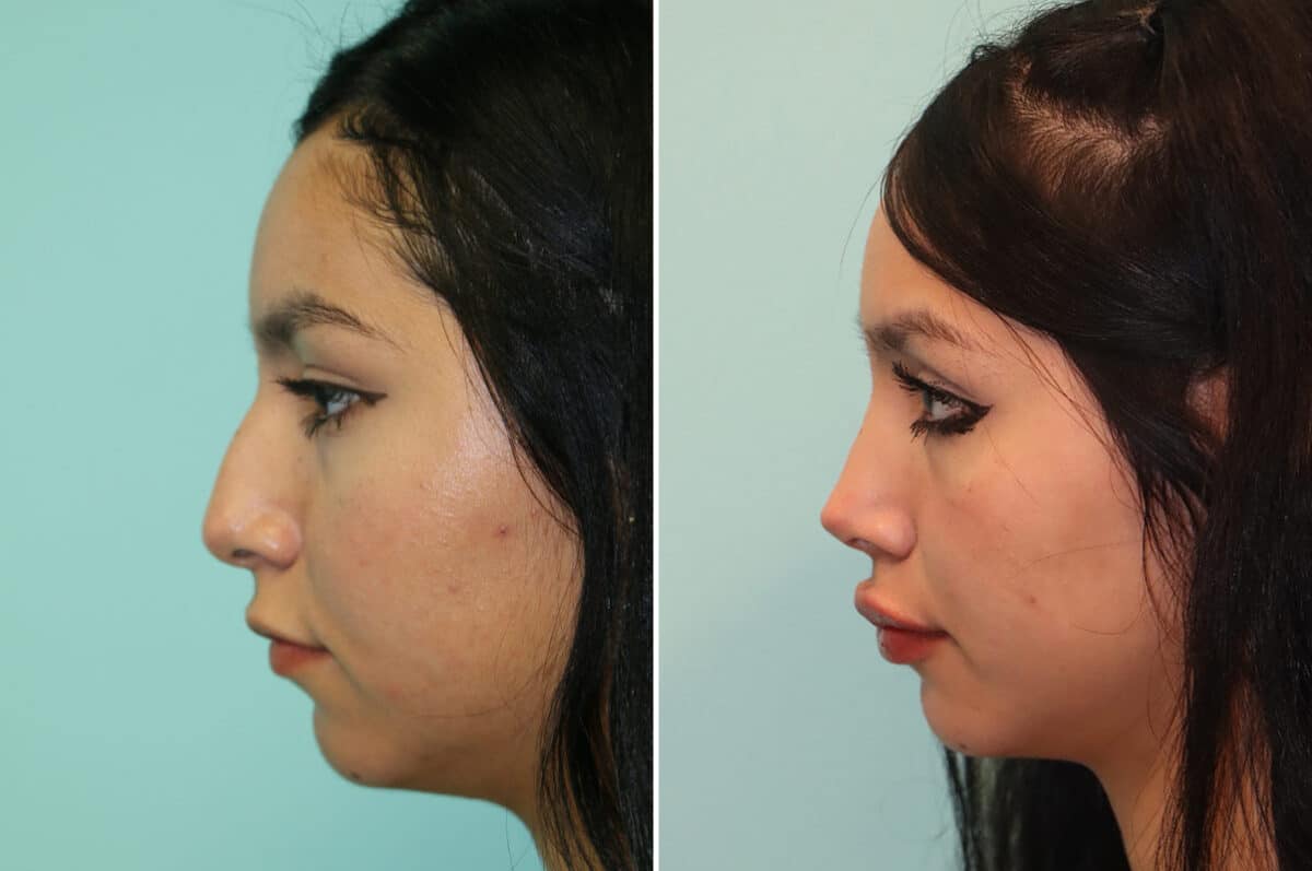 Before and after Rhinoplasty by Dr. Shervin Naderi, Patient 25270