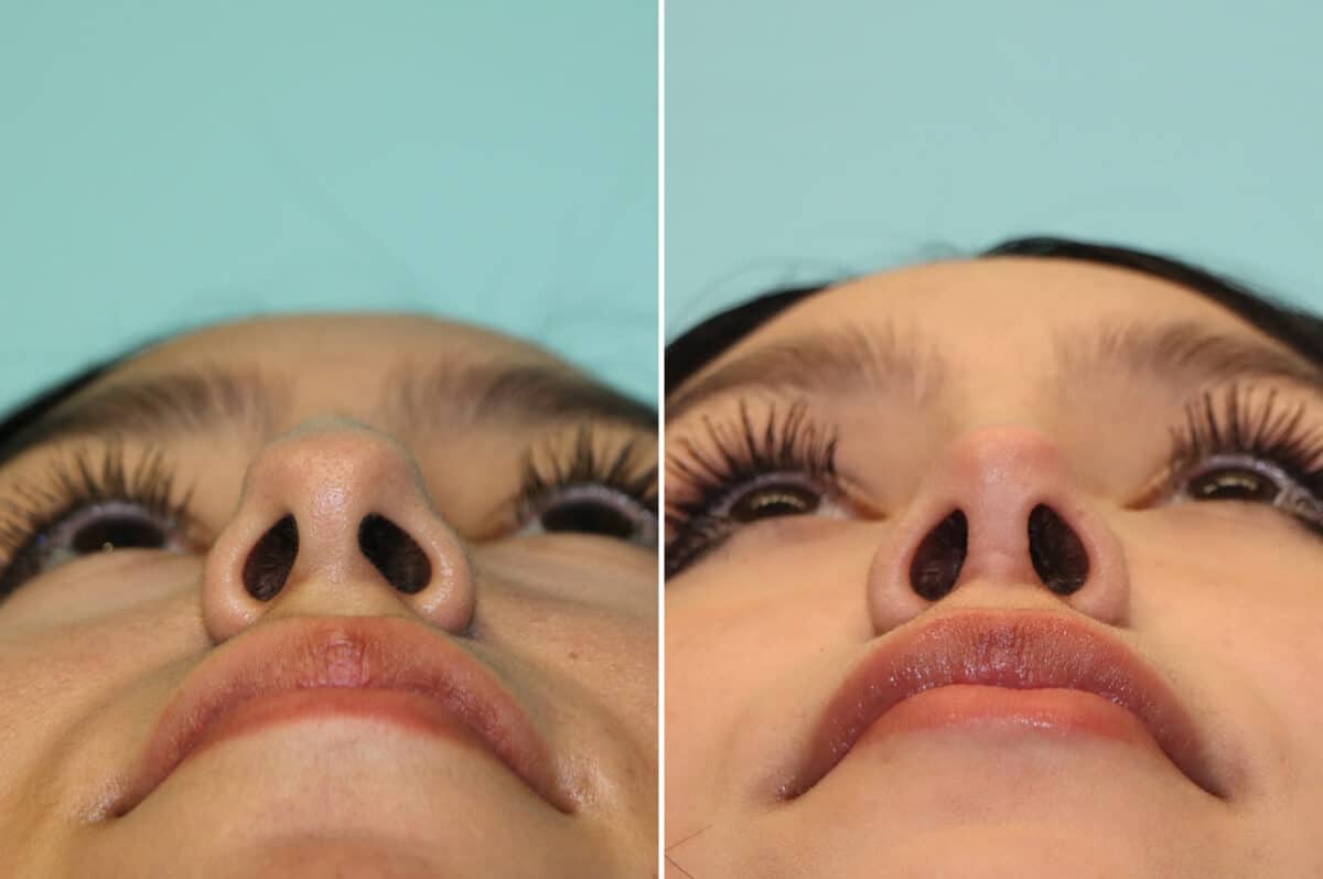 Before and after Rhinoplasty by Dr. Shervin Naderi, Patient 25270