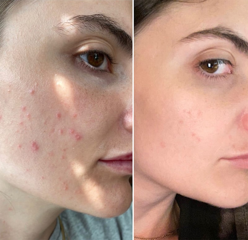 Before and after pictures of an acne patient.