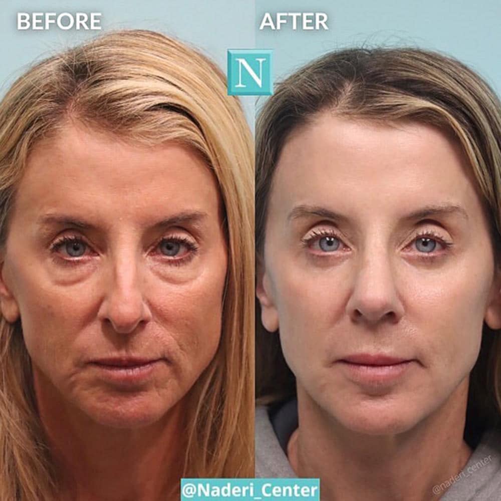 Mini Cheek Lift in Virginia, Washington D.C., and Maryland