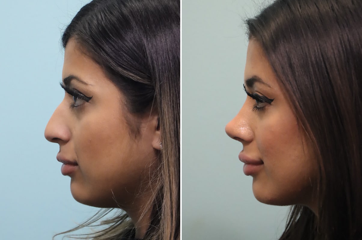Rhinoplasty photos Chevy Chase, MD Patient 25576