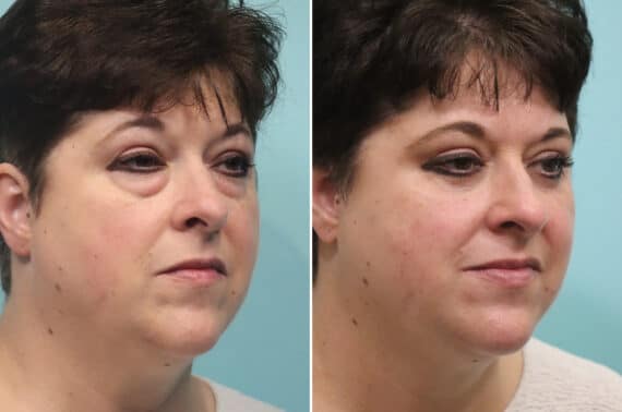 Before and after Blepharoplasty by Dr. Shervin Naderi, Patient 25599