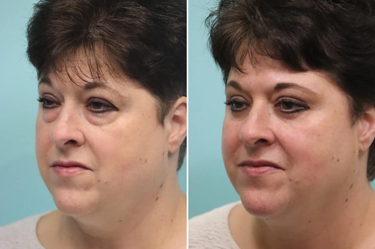 Before and after Blepharoplasty by Dr. Shervin Naderi, Patient 25599