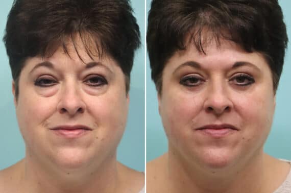 Before and after Blepharoplasty by Dr. Shervin Naderi, Patient 25599