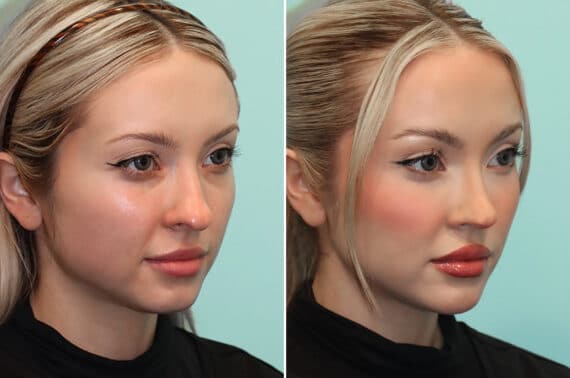 Before and after Rhinoplasty by Dr. Shervin Naderi, Patient 25610