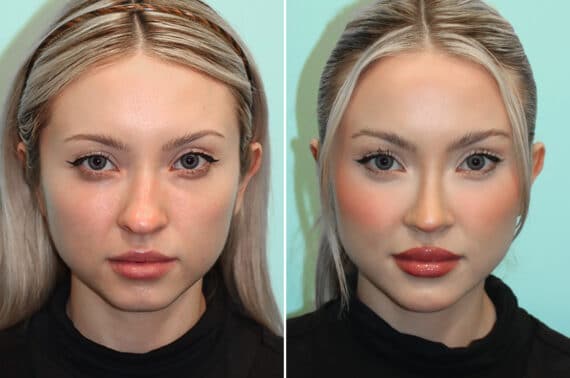 Before and after Rhinoplasty by Dr. Shervin Naderi, Patient 25610