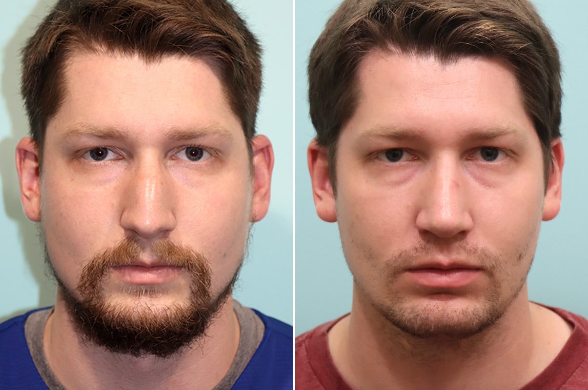 patient-25617-rhinoplasty-before-after