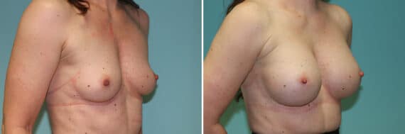 Before and after Breast Augmentation by Dr. Shervin Naderi, Patient 25644