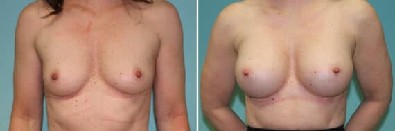 Before and after Breast Augmentation by Dr. Shervin Naderi, Patient 25644