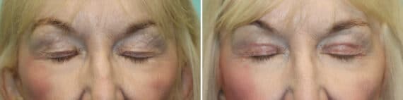 Before and after Blepharoplasty by Dr. Shervin Naderi, Patient 25661