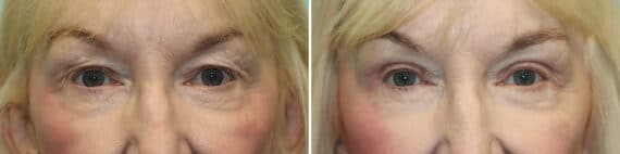 Before and after Blepharoplasty by Dr. Shervin Naderi, Patient 25661