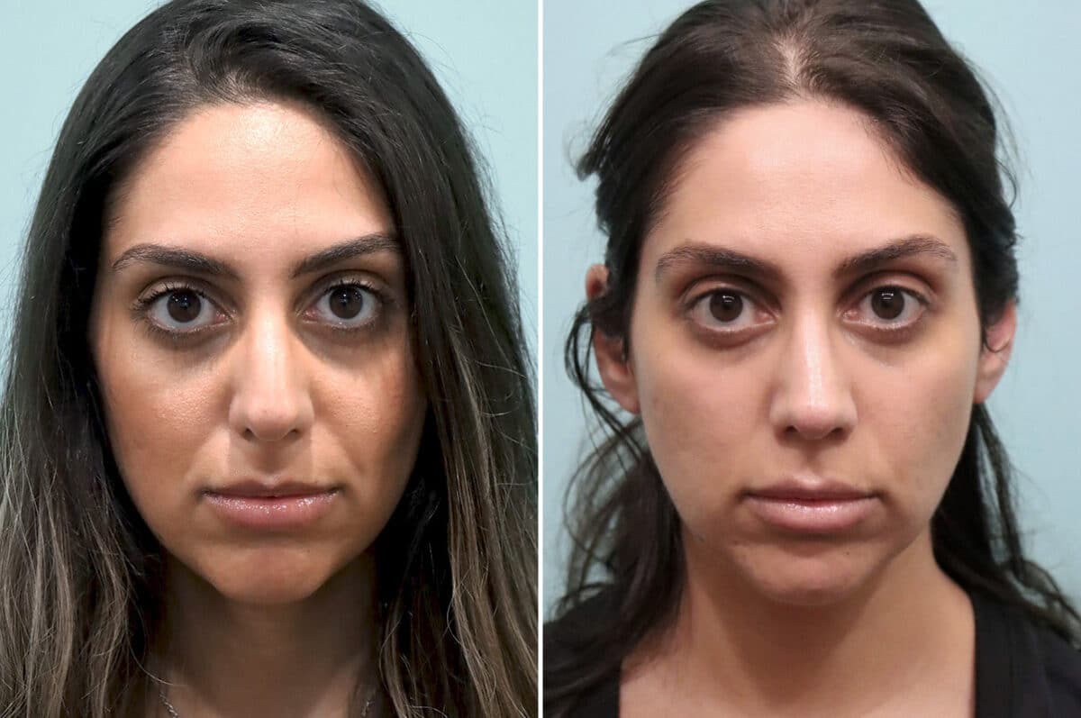 Patient 25669, Rhinoplasty Before and After Photos Before and after Rhinoplasty by Dr. Shervin Naderi, Patient 25669