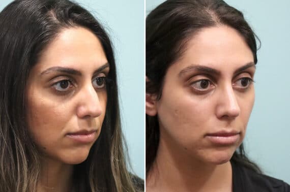 Before and after Rhinoplasty by Dr. Shervin Naderi, Patient 25669