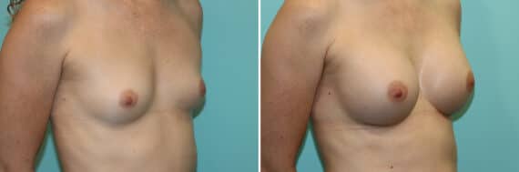 Before and after Breast Augmentation by Dr. Shervin Naderi, Patient 25755