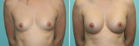 Before and after Breast Augmentation by Dr. Shervin Naderi, Patient 25755