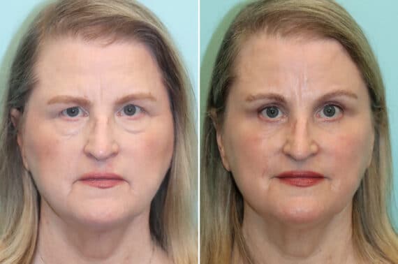 Before and after Blepharoplasty by Dr. Shervin Naderi, Patient 25772