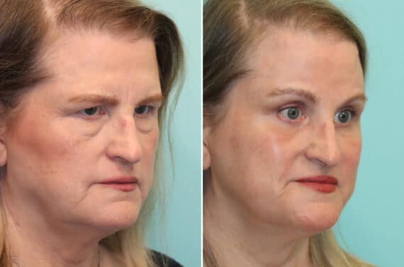 Before and after Blepharoplasty by Dr. Shervin Naderi, Patient 25772