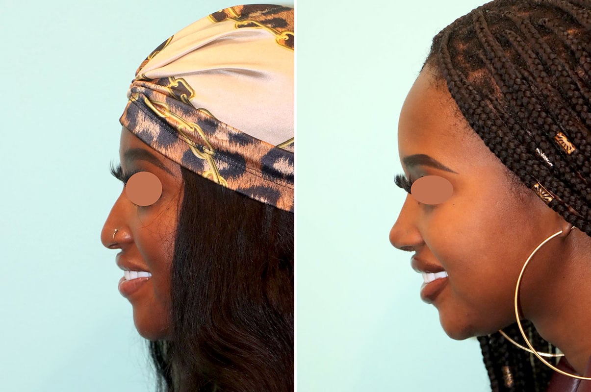 patient-25813-rhinoplasty-before-after