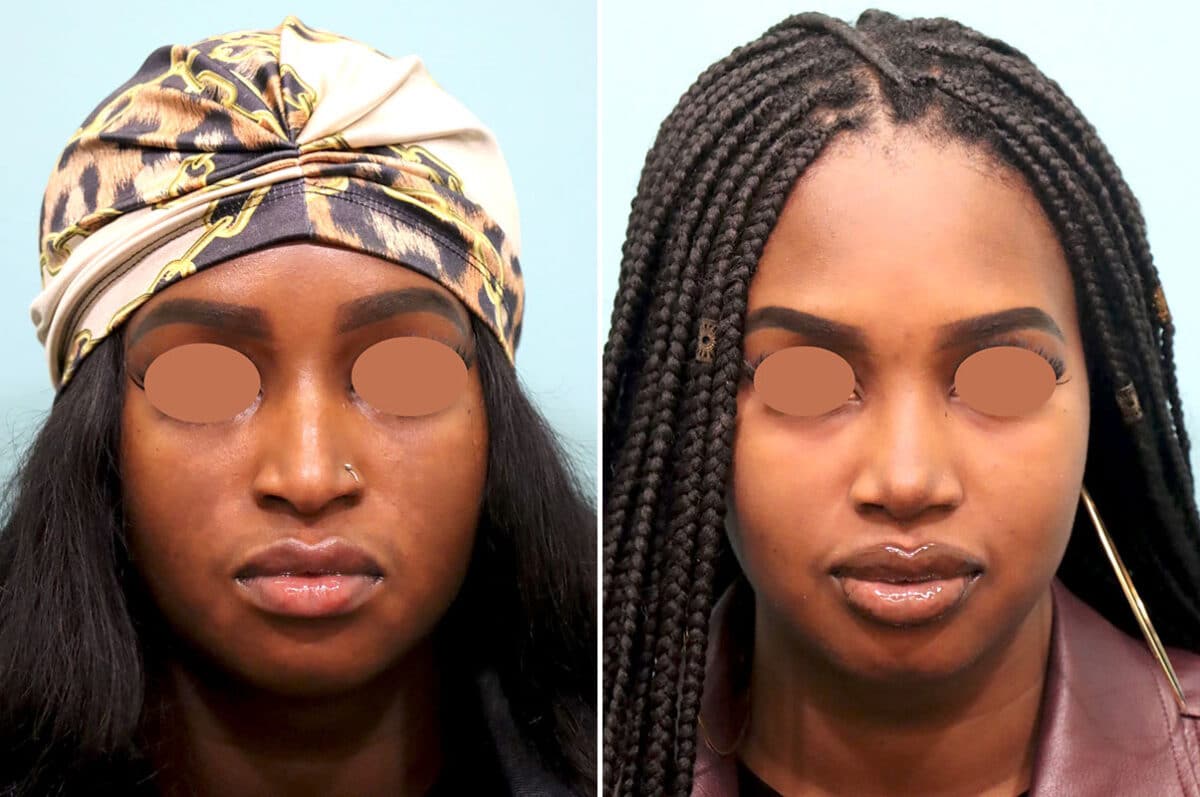 Patient 25813, Rhinoplasty Before and After Photos Before and after Rhinoplasty by Dr. Shervin Naderi, Patient 25813
