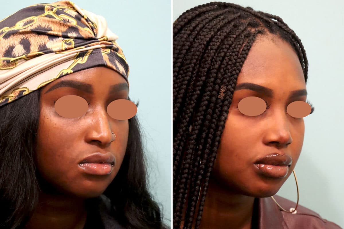 Patient 25813, Rhinoplasty Before and After Photos Before and after Rhinoplasty by Dr. Shervin Naderi, Patient 25813
