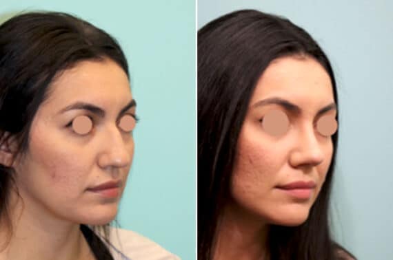 Before and after Rhinoplasty by Dr. Shervin Naderi, Patient 25844