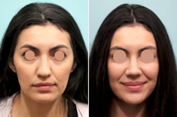 Before and after Rhinoplasty by Dr. Shervin Naderi, Patient 25844