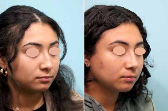 Before and after Rhinoplasty by Dr. Shervin Naderi, Patient 25866