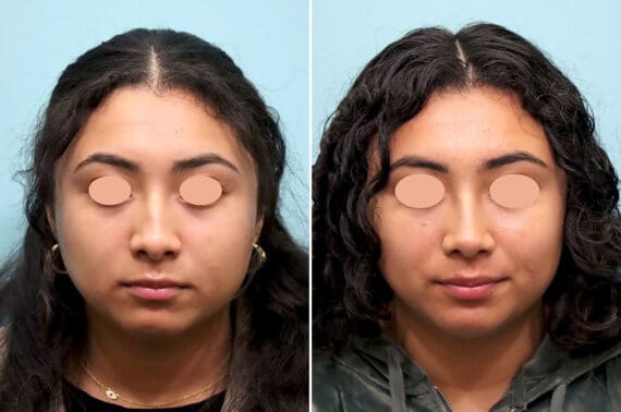 Before and after Rhinoplasty by Dr. Shervin Naderi, Patient 25866