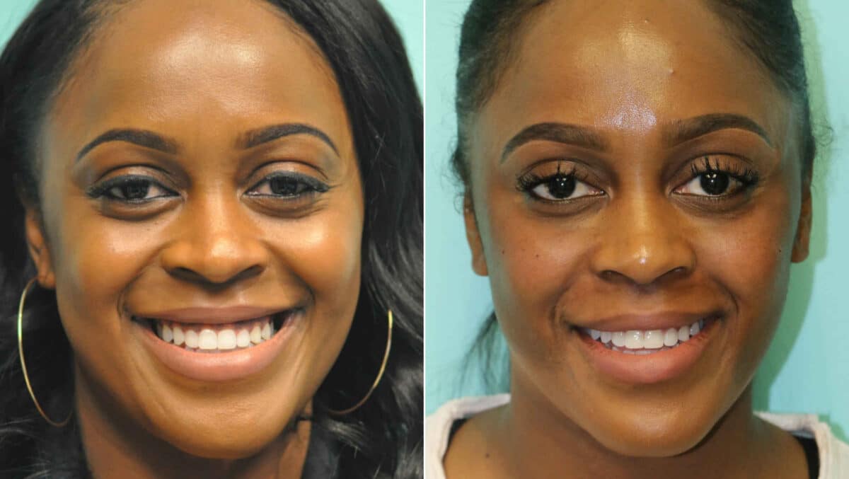 Before and after Botox Injections by Dr. Shervin Naderi, Patient 12680