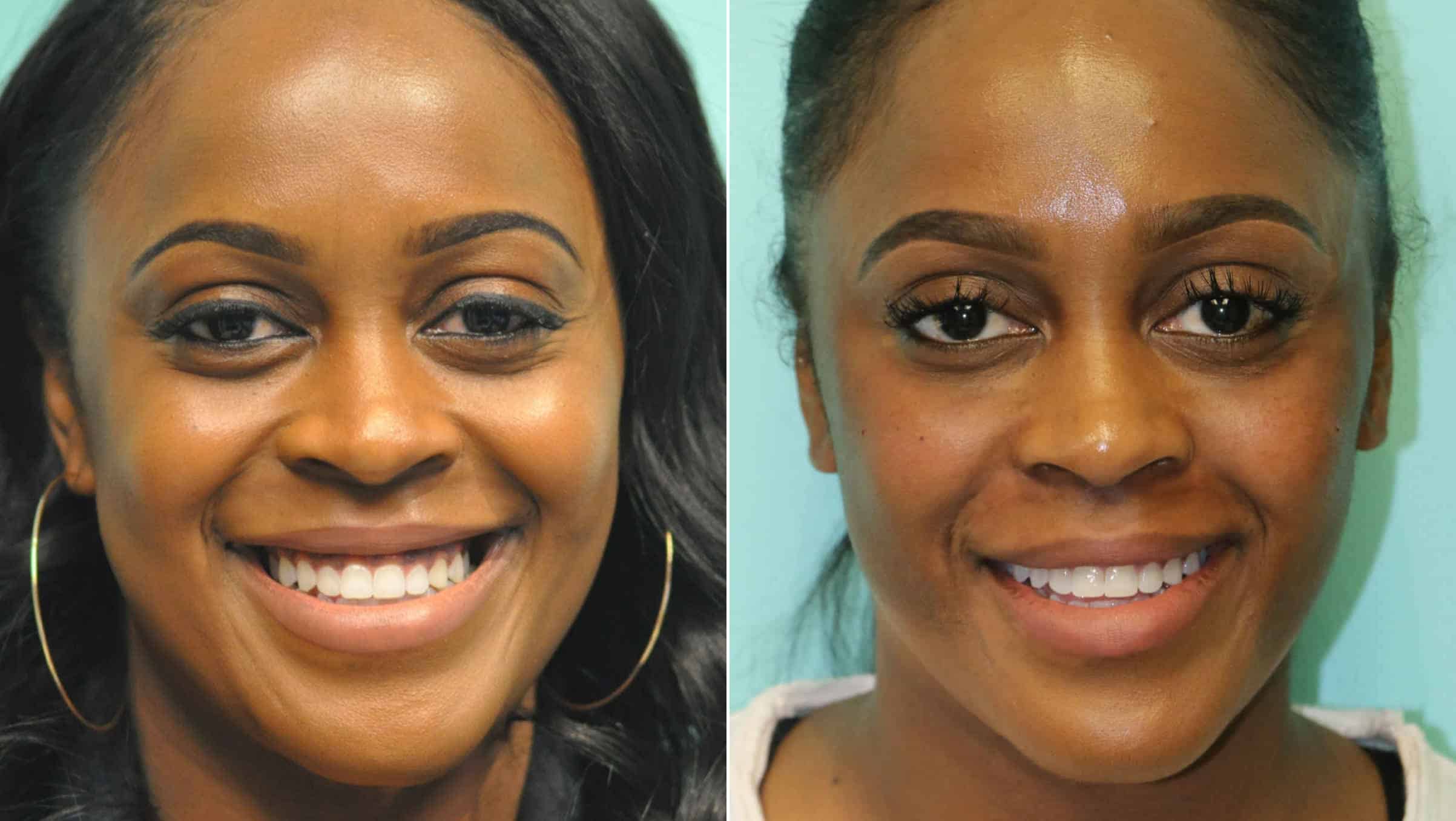 botox before and after injection for gummy smile