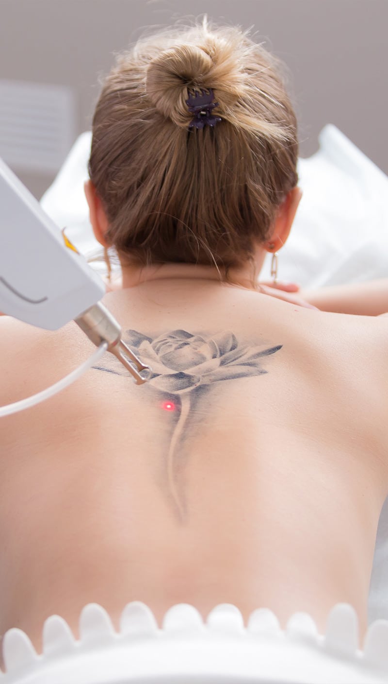 Laser tattoo removal on a floral tattoo on a woman's upper back