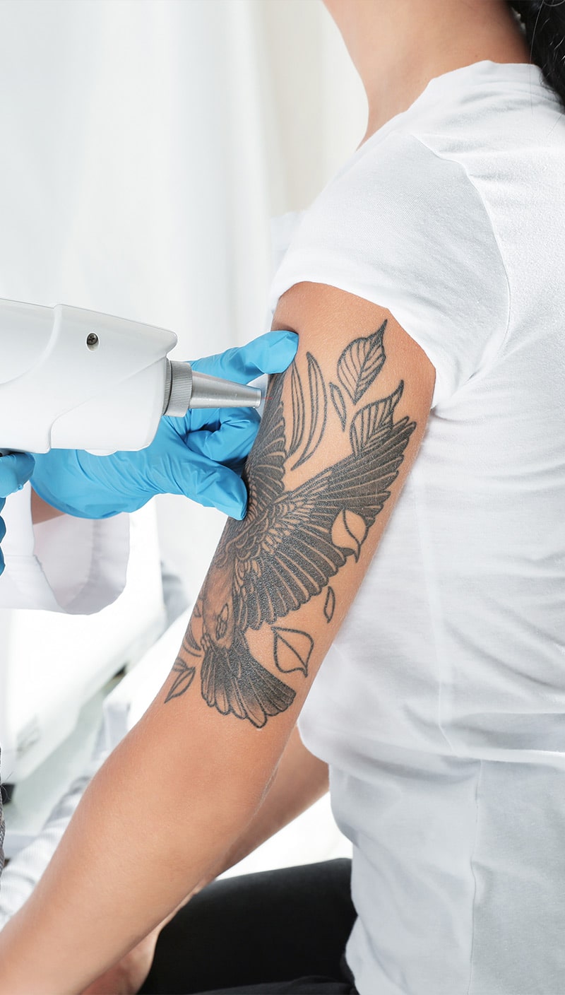 Provider performing laser tattoo removal on a large bird tattoo on a woman's upper arm