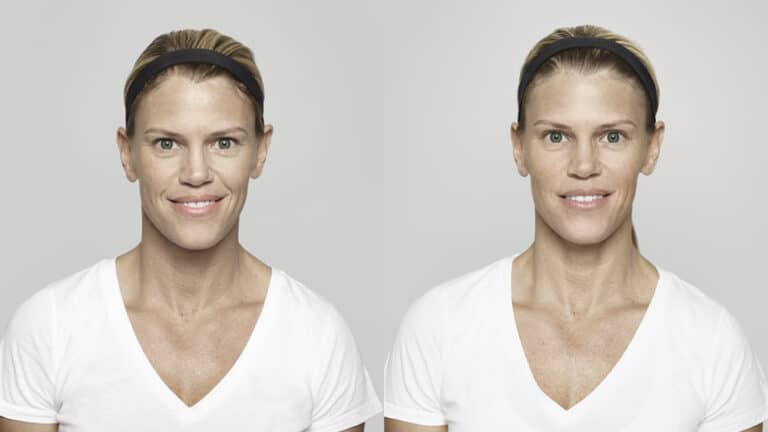 Restylane in Virginia, Washington D.C. & Maryland