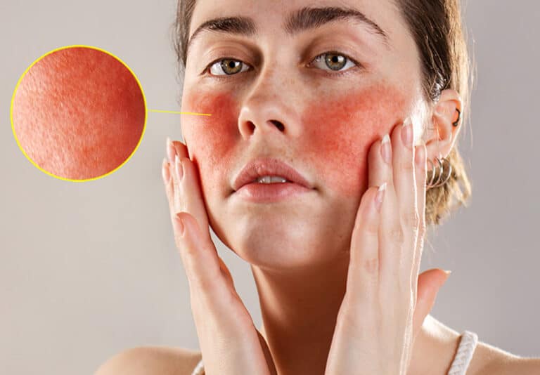 Woman with rosacea flushing across both cheeks