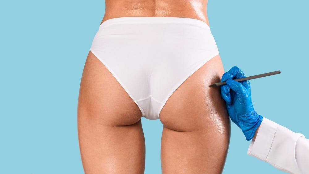 Longevity of Brazilian Butt Lift Results: How Long Does It Last?