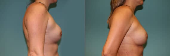 Before and after Breast Augmentation by Dr. Shervin Naderi, Patient 11097