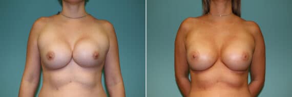 Before and after Breast Augmentation by Dr. Shervin Naderi, Patient 11097
