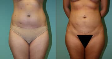 Before and after Liposuction by Dr. Shervin Naderi, Patient 11126