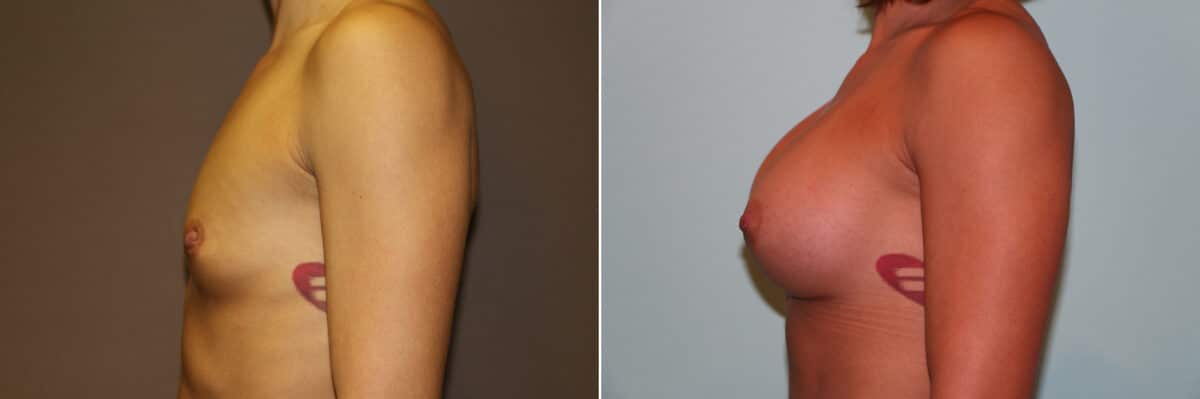 Patient 11275, Breast Augmentation Before and After Photos Before and after Breast Augmentation by Dr. Shervin Naderi, Patient 11275